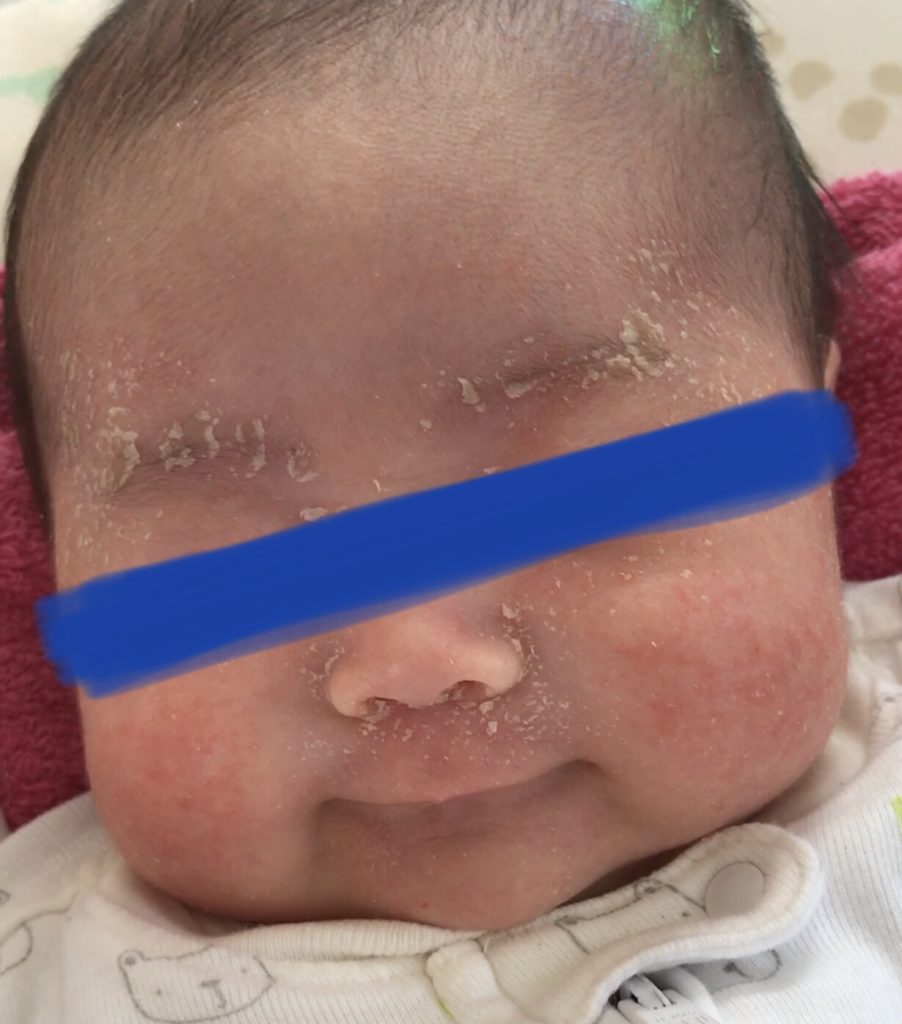 【乳児湿疹】赤ちゃんの脂漏性湿疹に悩んだ時に試したこと uniko life